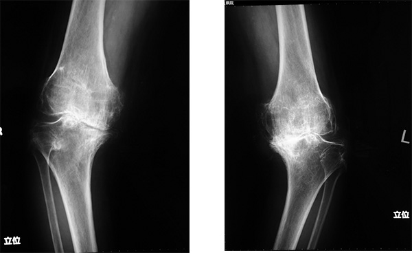 人工膝関節置換術前の膝（変形性膝関節症）