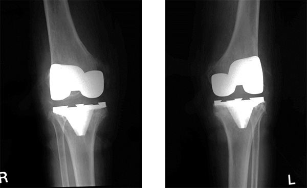人工関節手術後の膝