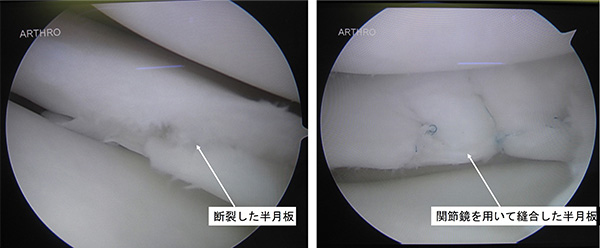 関節鏡視下半月板縫合術