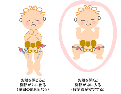 お股が閉じると関節が外に出る（脱臼の原因となる）　お股を開くと関節が中に入る（股関節が安定する）