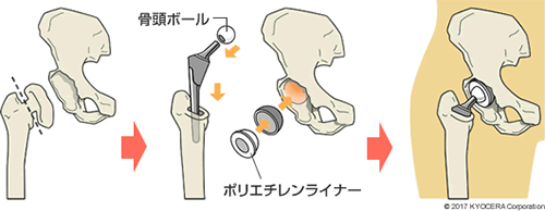 人工股関節置換術のイメージ図