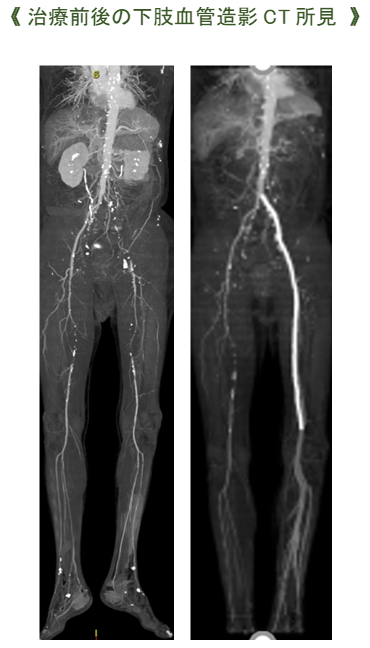 治療前後の下肢血管造影CT所見