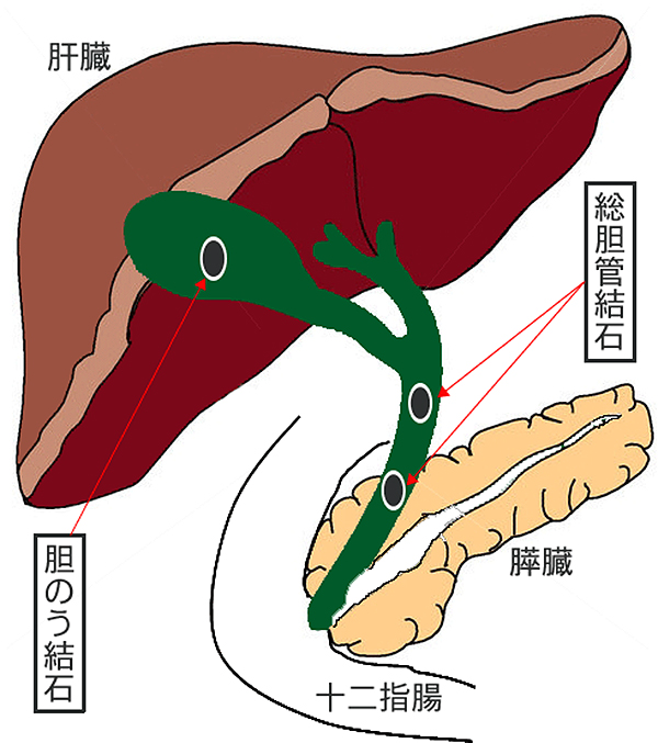 胆石 症 について 正しい の は どれ か